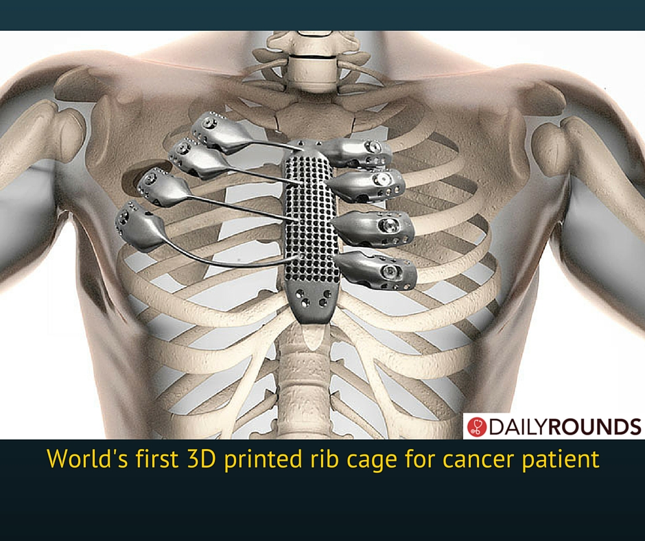3-D Printer Uses Metal To Make Custom Rib Cage For Cancer Patient