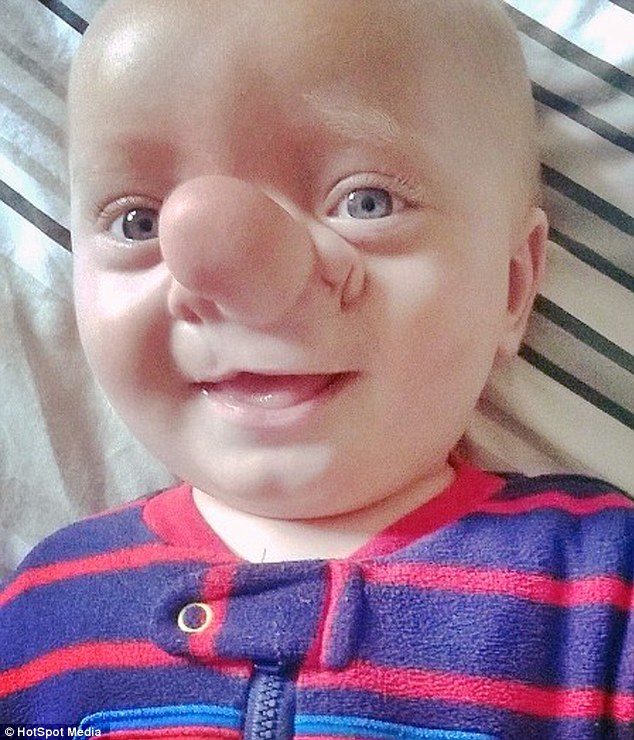 Pinnochio Baby: Toddler born with rare birth defect, has brain growing ...