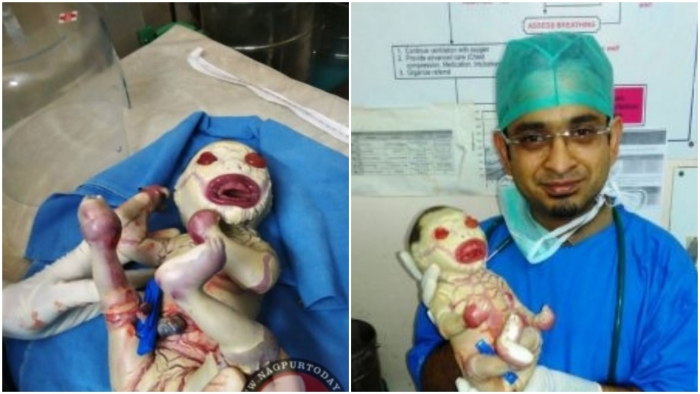 Nagpur baby not the first Harlequin child in India ...