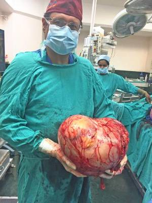 World’s Largest Adrenal Tumor